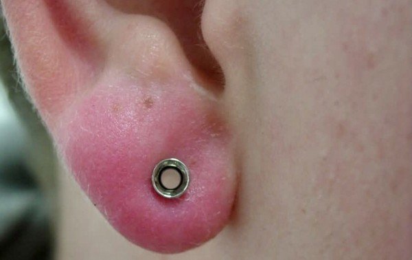 Lỗ đeo bông tai bị sưng